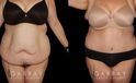 Abdominoplasty patient results, highlighting the loose skin and folds before the procedure. Following surgery, the patient recovered without complications and saw lasting tummy tuck results with a flatter profile.