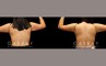 Patient 05 Back View Crecent Mini Arm Lift Gabbay Plastic Surgery