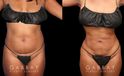 Female patient’s liposuction results, tightening her abdomen area significantly while minimizing any scarring. Patient recovered without complications and enjoyed an enhanced visibility of her natural curvy contours.