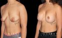 Procedures Depicted:  Breast Augmentation w/ Mastopexy – Silicone