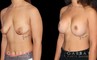 Procedures Depicted:  Breast Augmentation w/ Mastopexy – Silicone