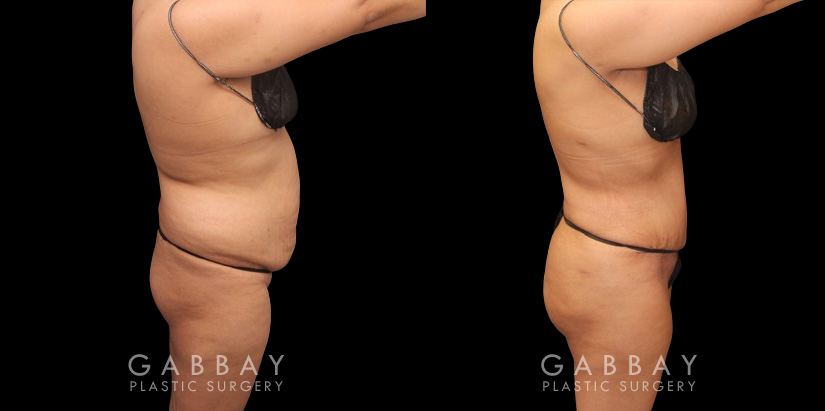 Before and after photos showing a female patient with substantial liposuction and fat transferred from around the abdomen, waist, and back to buttocks. Full and round shape improvement to the buttocks (without butt implants) by a leading Brazilian butt lift specialist and dramatic body contouring through 360 liposuction.