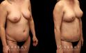 Before and after a mommy makeover consisting of two procedures: tummy tuck and a breast lift. Drooping breasts were repositioned to a higher, firmer aesthetic while targeted abdominal liposuction and tightening restored a prepregnancy contour to the body and silhouette.