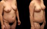 Before and after a mommy makeover consisting of two procedures: tummy tuck and a breast lift. Drooping breasts were repositioned to a higher, firmer aesthetic while targeted abdominal liposuction and tightening restored a prepregnancy contour to the body and silhouette.