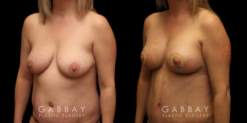 Procedures Depicted:  Breast aug/pexy and tummy tuck