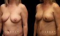 Procedures Depicted:  Breast aug/pexy and tummy tuck