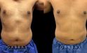 Male patient following 360 liposuction to the abdomen, sides, and back for a more youthful contour while maintaining a masculine feel to the body shape. The result is a tighter overall torso appearance.