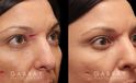 Patient 02 3/4th Right View Scar Revision to Eyebrow Gabbay Plastic Surgery
