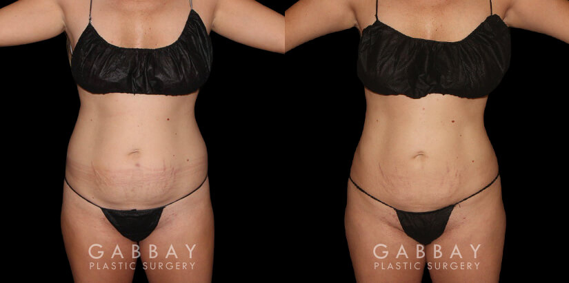 Procedures Depicted:  BBL, Lipo to Abdomen, Waist, and Tailbone, Fat Transfer to Butt. Results for a patient with 360 liposuction for abdomen, waist, and tailbone for a BBL fat transfer surgery. Note the flattened stomach and enhanced shape of the buttocks for a more impressive figure overall.