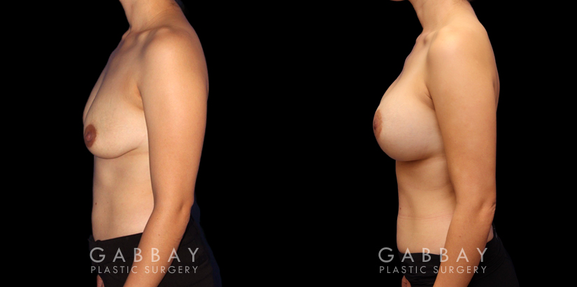 Procedures Depicted:  Scar Revision to Breasts