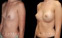 Before and after silicone breast implants for breast augmentation. Note the natural slope to the breasts and the symmetrical appearance while still increasing overall size.