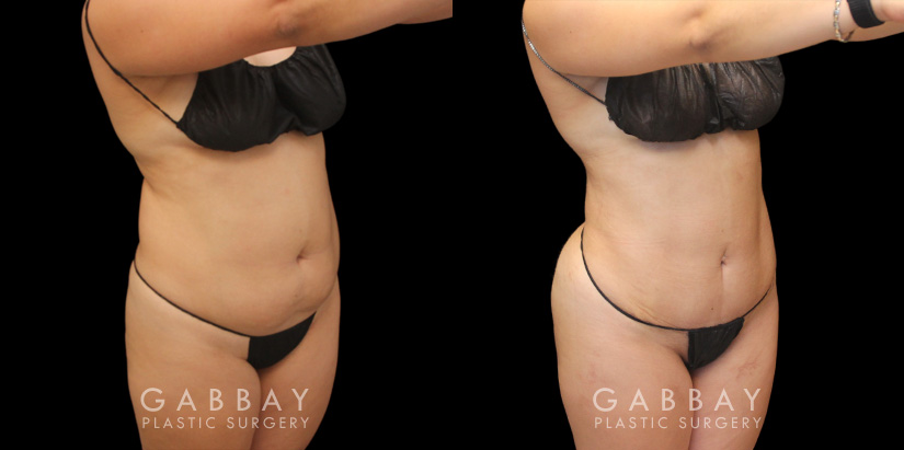 Patient 08 Front View Mini Tummy Tuck Gabbay Plastic Surgery