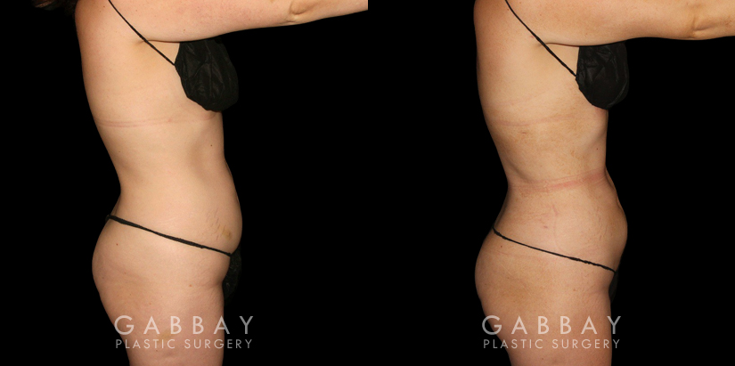 Procedures Depicted:  Mastopexy and Liposuction Before-and-after photos for female patient who underwent both a breast lift and belly fat removal via liposuction. Results together create a full ‘lifted’ appearance for the patient’s entire body.
