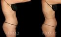 Procedures Depicted:  Mastopexy and Liposuction Before-and-after photos for female patient who underwent both a breast lift and belly fat removal via liposuction. Results together create a full ‘lifted’ appearance for the patient’s entire body.