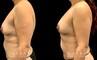 Patient 17 Left Side View Breast Fat Grafting Gabbay Plastic Surgery