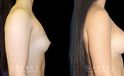 Patient with silicone implants, photos demonstrating final breast size after complete and uncomplicated recovery period. Note the improved profile and side angles, with no visible scarring.