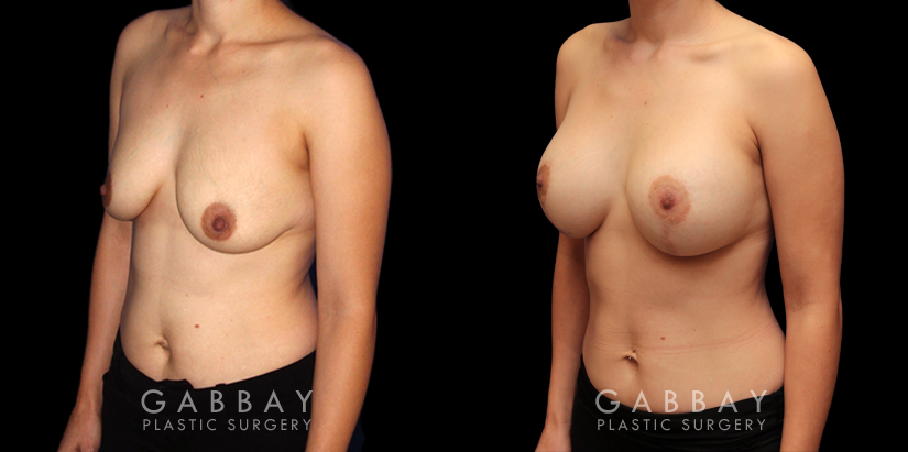 Procedures Depicted:  Scar Revision to Breasts