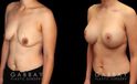 Procedures Depicted:  Scar Revision to Breasts