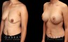 Procedures Depicted:  Scar Revision to Breasts