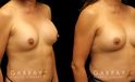 Patient before-and-after photos for implant removal and replacement procedure. This revision breast augmentation went well and patient was satisfied with how her new implants looked and felt.