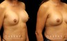 Patient before-and-after photos for implant removal and replacement procedure. This revision breast augmentation went well and patient was satisfied with how her new implants looked and felt.