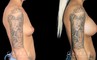 Before-and-after photos for breast augmentation with saline implants. The choice of saline implants allowed for more dramatic increase in breast size while having no visible scars.