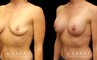 Patient with combined areola lift and breast augmentation, photos showing her before and after the procedure. Not the improved breast position and increased volume.
