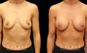 Silicone breast augmentation results after full recovery. Multi-angle view shows the boost to volume from each side for an alluring profile.