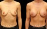 Silicone breast augmentation results after full recovery. Multi-angle view shows the boost to volume from each side for an alluring profile.