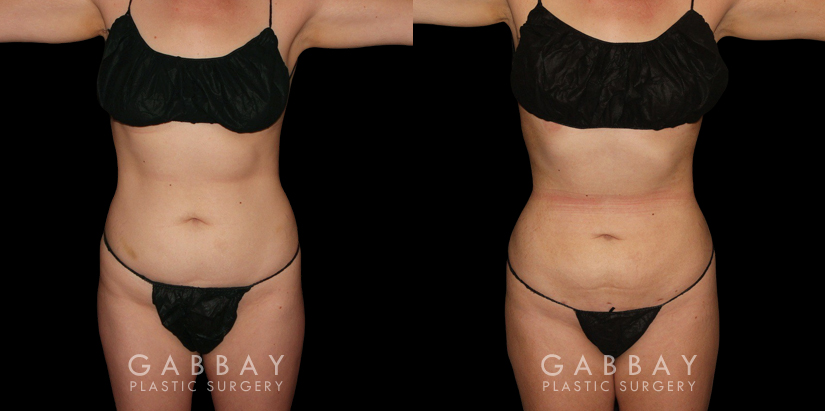 Procedures Depicted:  Mastopexy and Liposuction Before-and-after photos for female patient who underwent both a breast lift and belly fat removal via liposuction. Results together create a full ‘lifted’ appearance for the patient’s entire body.