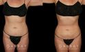 Procedures Depicted:  Mastopexy and Liposuction Before-and-after photos for female patient who underwent both a breast lift and belly fat removal via liposuction. Results together create a full ‘lifted’ appearance for the patient’s entire body.