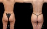 Post-op photos of mid-30s female patient for mini BBL surgery. As a mini BBL, precise liposuction resulting in enhanced body sculpting with a subtle yet marked increase in butt size, shape, and volume. Almost perfectly rounded buttocks resulted after fat settled for the patient's final results. Note the increase in abdominal contour from front and side views.