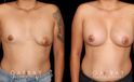 Before-and-after photos for patient with unilateral breast lift and bilateral breast augmentation. The improved symmetry restored a more natural look to the breasts with even nipple position.