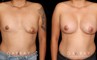 Before-and-after photos for patient with unilateral breast lift and bilateral breast augmentation. The improved symmetry restored a more natural look to the breasts with even nipple position.