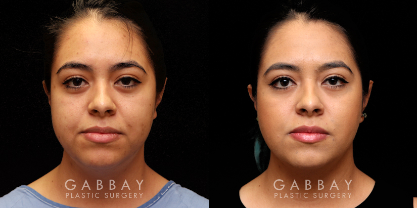 Procedures Depicted:  Buccal Fat Pad Removal