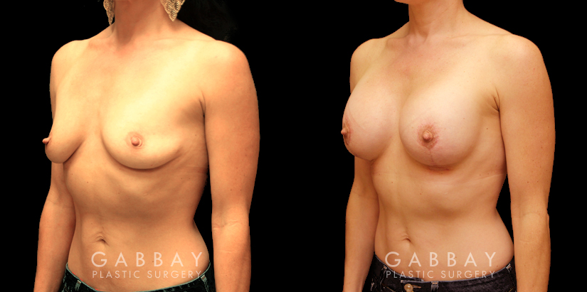 Procedures Depicted:  Breast augmentation with areola lift