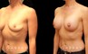Procedures Depicted:  Breast augmentation with areola lift