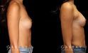 Patient before and after silicone breast augmentation. Patient’s slimmer body matched smaller implants to maintain a balance with her natural figure.