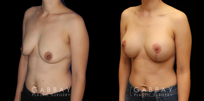 Procedures Depicted:  Augpexy