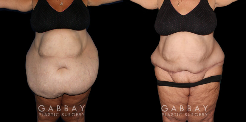 Patient 01 Right Side View Abdominal Panniculectomy Gabbay Plastic Surgery