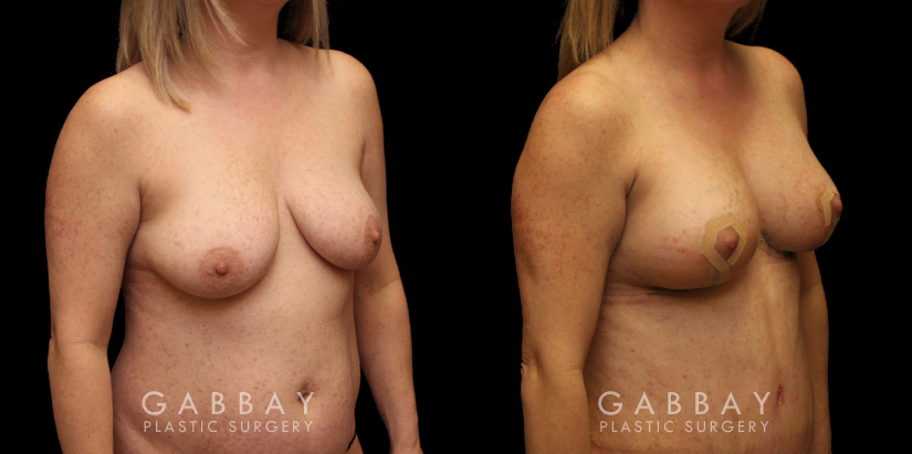 Procedures Depicted:  Breast aug/pexy and tummy tuck