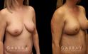 Procedures Depicted:  Breast aug/pexy and tummy tuck