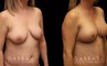 Procedures Depicted:  Breast aug/pexy and tummy tuck