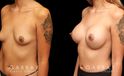 Patient with breast augmentation. Maintained the patient’s natural breast positions while increasing size for a natural look while still improving the aesthetic by boosting volume.