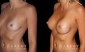 Breast augmentation before-and-after photos for patient with silicone implants. Increased volume resulted in pleasantly round breasts without excessive change.
