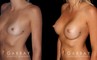 Breast augmentation before-and-after photos for patient with silicone implants. Increased volume resulted in pleasantly round breasts without excessive change.