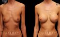 Patient wanted dramatic increase in breast volume using silicone implants. Breast position was not changed, with the main focus being boost to size and roundness of the breasts.