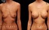 Patient wanted dramatic increase in breast volume using silicone implants. Breast position was not changed, with the main focus being boost to size and roundness of the breasts.