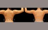 Procedures Depicted:  Arm liposuction with J Plasma