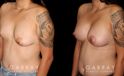 Before-and-after photos for patient with unilateral breast lift and bilateral breast augmentation. The improved symmetry restored a more natural look to the breasts with even nipple position.